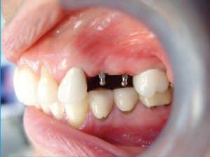mini dental implants Cleveland, OH