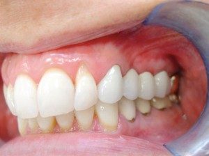 mini dental implants Cleveland, OH